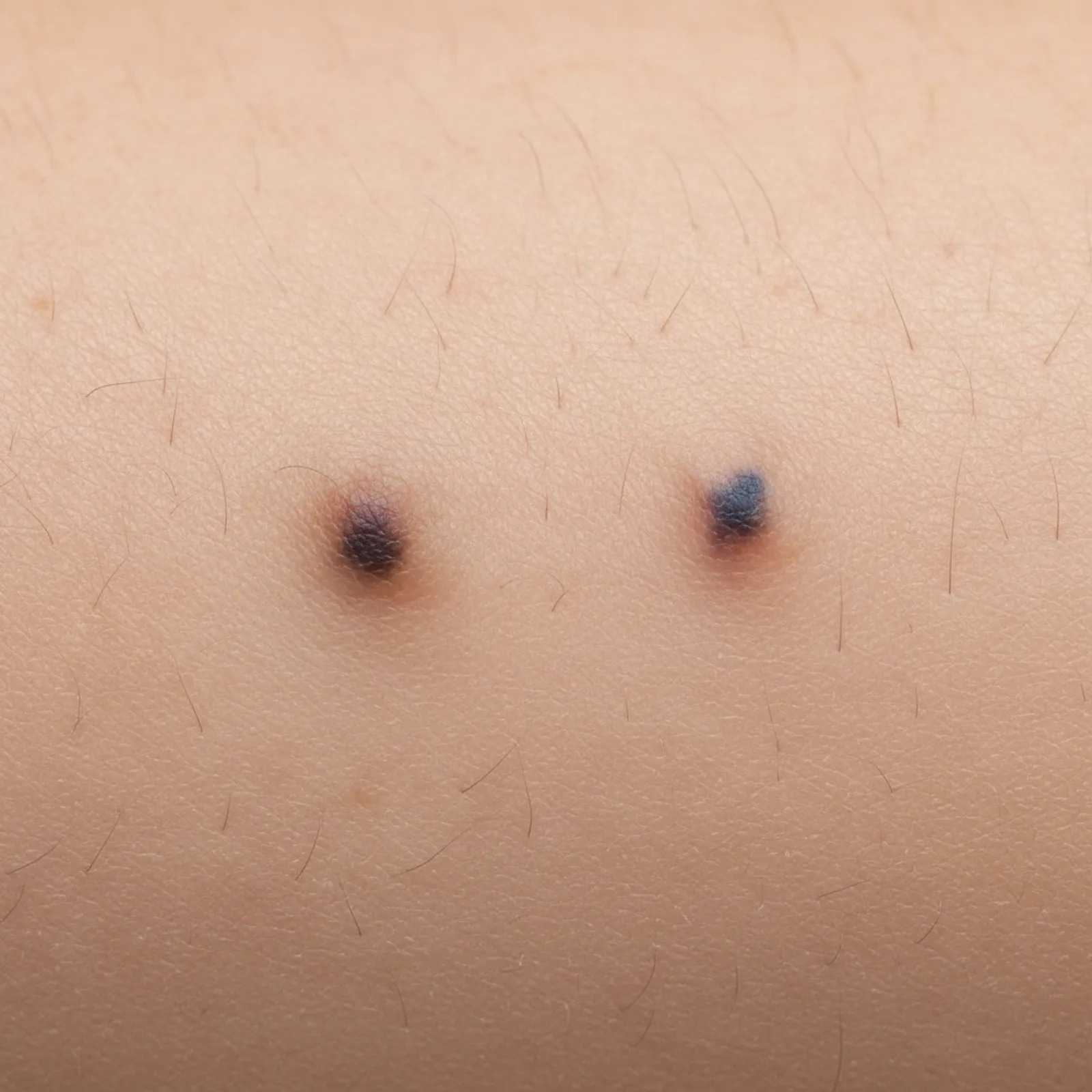 Как проявляется меланома